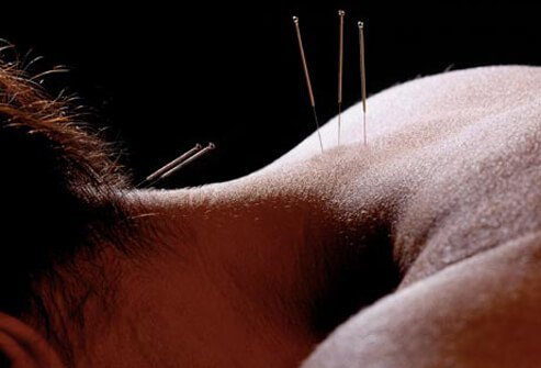 Nature Acupuncture